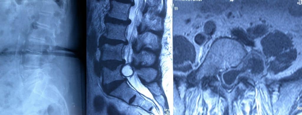 Figura 3.- Rx con agrandamiento del agujero de conjunción a nivel L5-S1 por neurinoma en reloj de arena