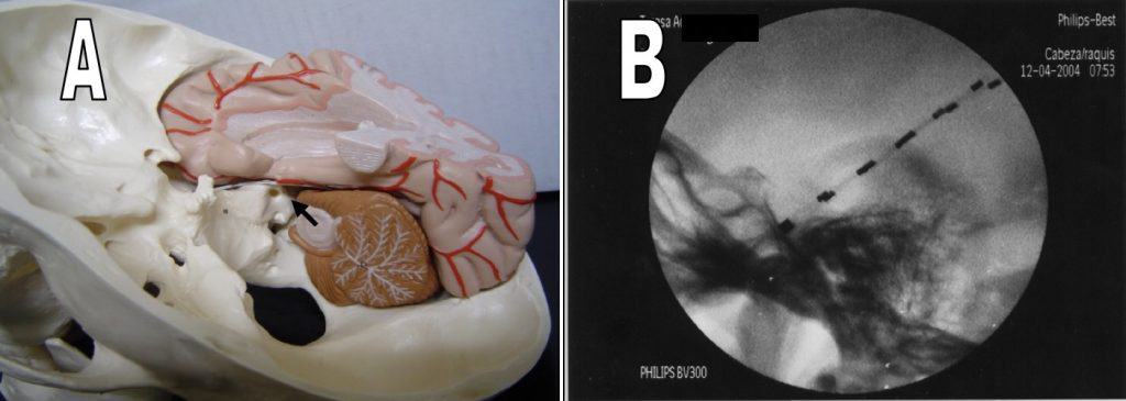 Figura 4. Electrodos de foramen oval. A) Modelo plástico de lóbulo temporal y hemisferio cerebeloso derechos. Se ha introducido un EFO real (flecha). B) Fluoroscopia intraoperatoria lateral que muestra la implantación de dos EFO.