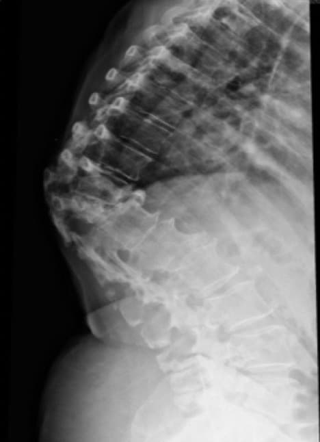 Figura 4.- RX de columna dorsal con aplastamiento vertebral