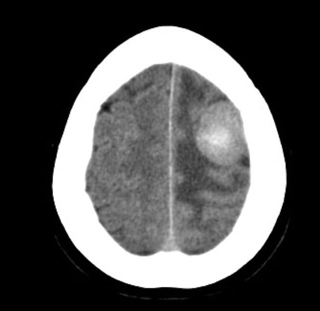 Figura 4.- TAC craneal: meningioma a nivel de convexidad.