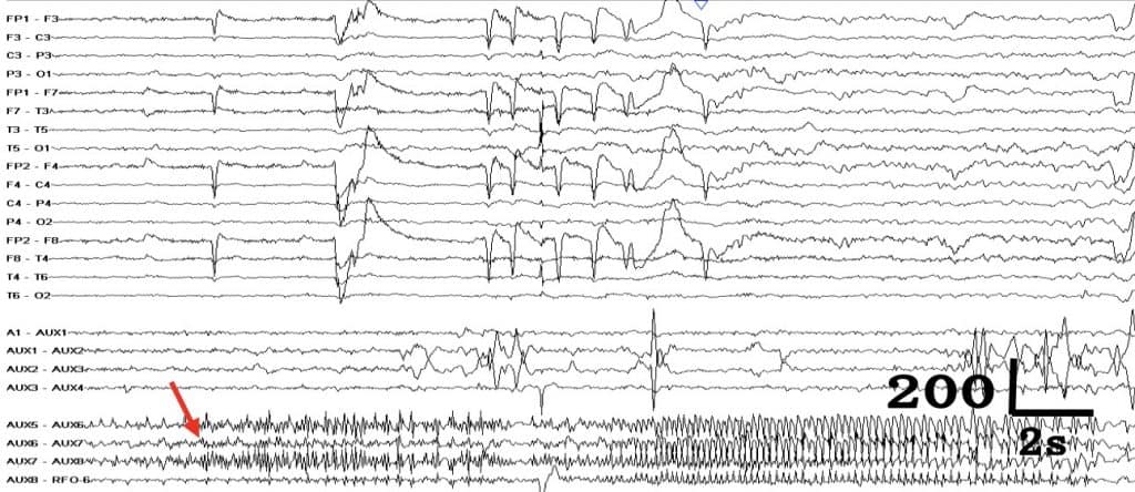 Figura 5. Ejemplo de registro ictal en un paciente con EFO. Arriba, los 16 canales del EEG superficial. En medio, los 4 canales del EFO izquierdo. Abajo, los 4 canales del EFO derecho. Se observa el origen de la crisis en electrodos de región temporal medial derecha (flecha), sin repercusión en el EEG superficial o EFO izquierdo.