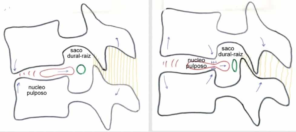 Figura 5.- Mecanismo de producción de una hernia discal