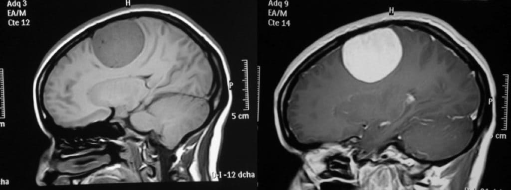 Figura 5.- RM sagital sin y con contraste de meningioma parasagital.