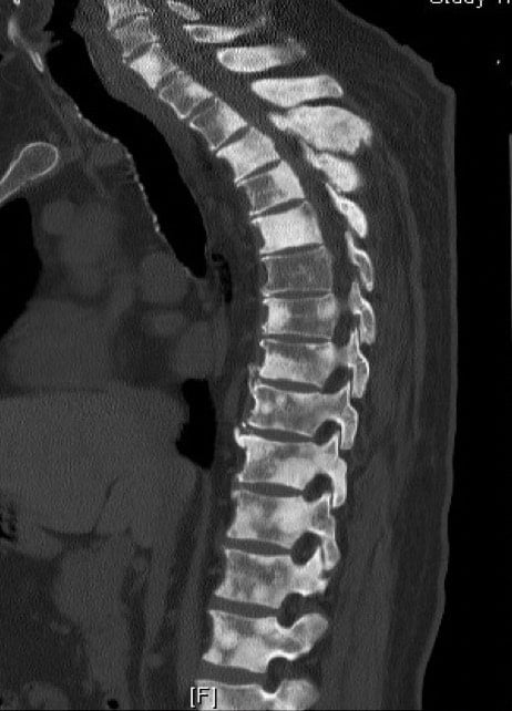 Figura 5.- TAC de columna se ve afectación metastásica de varios cuerpos vertebrales