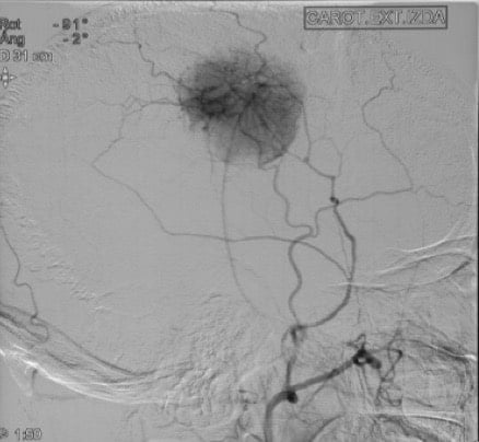 Figura 6.- Angiografía cerebral. Se observa una hipervascularización nodular, con origen en ramas meníngeas, que corresponde a un meningioma.