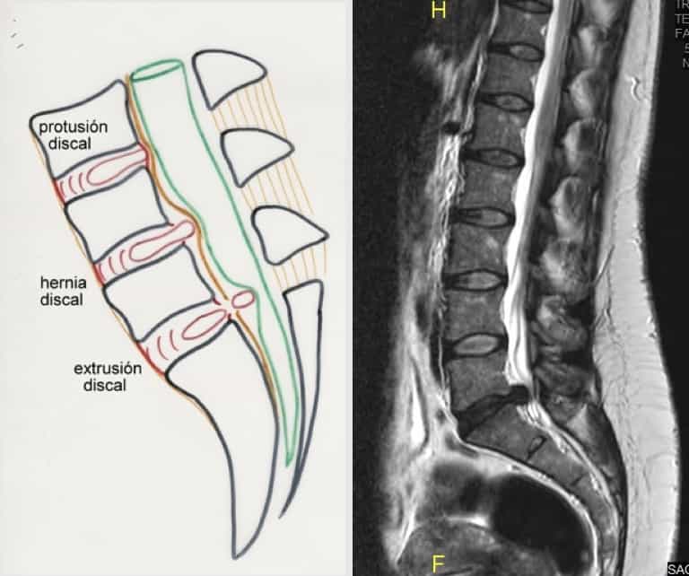 Figura 6.- Esquema de los tipos de hernia. RM sagital con hernia discal masiva en el espacio L5-S1