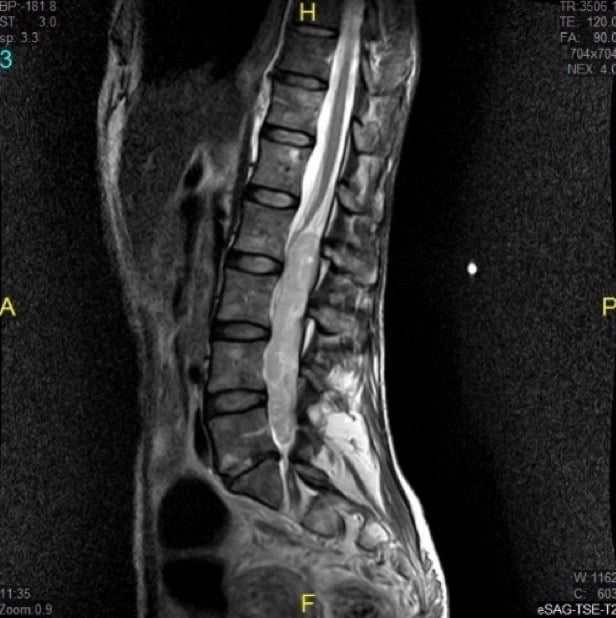 Figura 6.- RM lumbar se observa una masa tumoral dentro del canal, desde L2 a L5 (Ependimoma)
