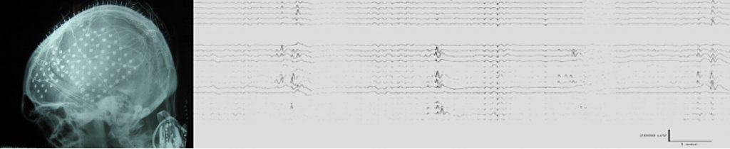 Figura 6. Radiografía lateral de paciente estudiado con electrodos subdurales. En la parte derecha se observa un registro característico con electrodos subdurales.