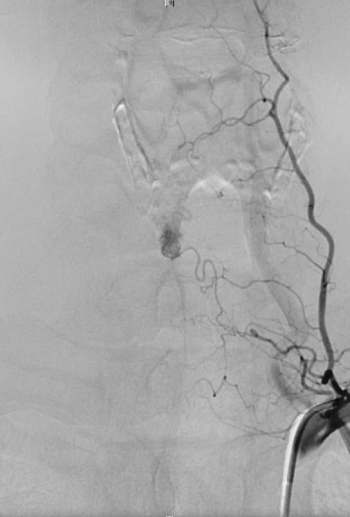 Figura 7.- Arteriografia medular