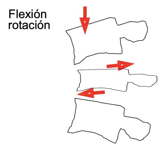 Figura 7.- Esquema de lesión por flexión rotación