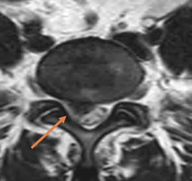 Figura 7.- RMN lumbar, corte axial con extrusión discal