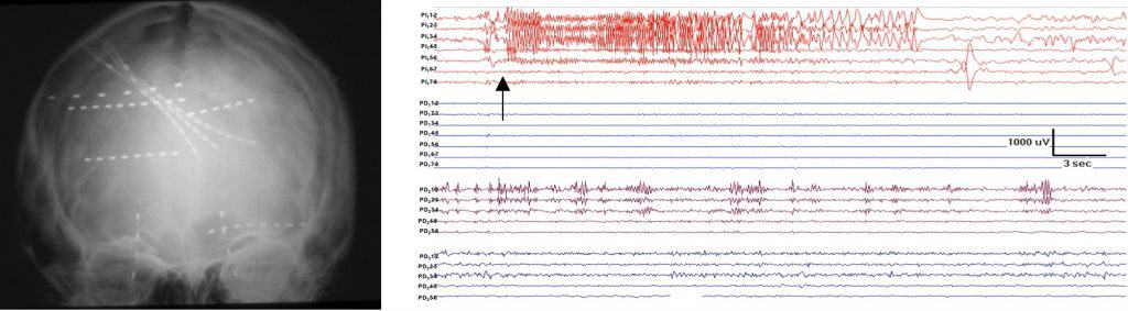 Figura 7. Radiografía A-P de paciente estudiado con electrodos profundos, insertados perpendicularmente a la superficie cortical. En la parte derecha se observa una crisis registrada mediante electrodos profundos (flecha), muy focalizada en uno de ellos.