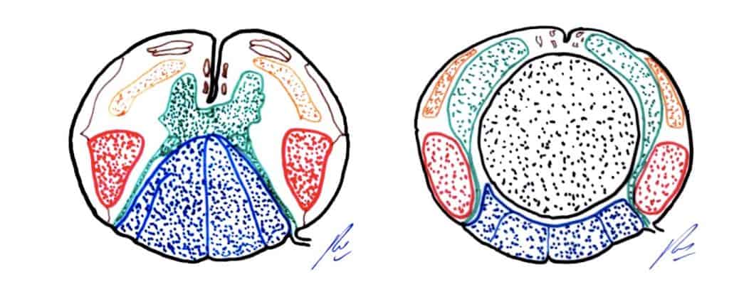 Figura 8.- Esquema de crecimiento de un tumor intramedular (Ependimoma, en negro). Azul.- Cordones posteriores. Rojo.- Haz piramidal. Amarillo.- Haz espino-talámico. Verde.- Astas anteriores y posteriores.