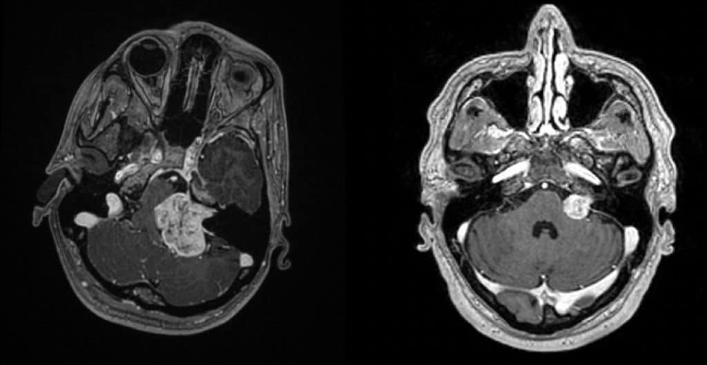 Figura 8.- RM axial. A la izquierda se observa un neurinoma de gran tamaño y a la derecha de pequeño tamaño.