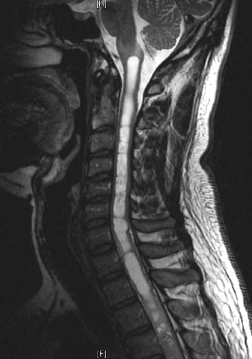 Figura 9 .- RM de columna cervical con ependimoma extenso desde el bulbo hasta médula torácica