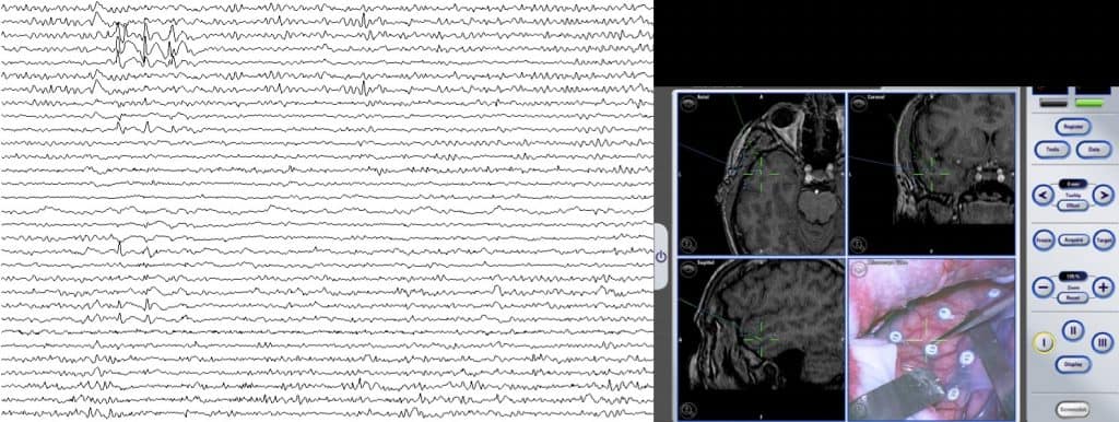 Figura 9. Electrocorticografía. En la parte izquierda se muestra un típico registro ECoG intraoperatorio. A la derecha se observa la situación de la manta sobre la región temporal. En conjunción con el sistema de neuronavegación (microscopio y puntero).