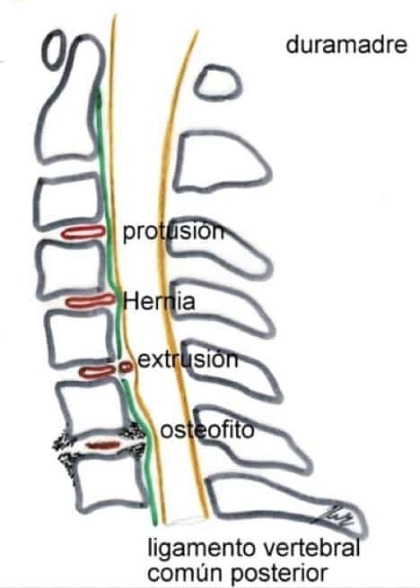 Figura 9.- Esquema de las alteraciones sobre una columna cervical. La estenosis por osteofitosis e hipertrofia de ligamentos es más frecuente en la columna cervical