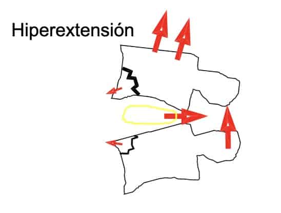 Figura 9.- Esquema de lesión por hiperextension