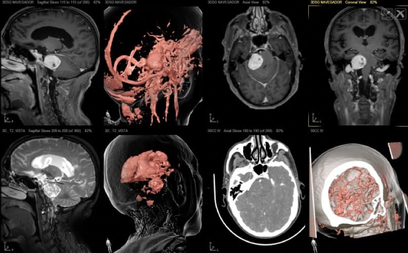 Figura 9.- Imágenes de la preparación preoperatorias de un Neurinoma del VIII derecho.