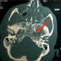Figura 10.- TAC craneal con fractura de base de cráneo
