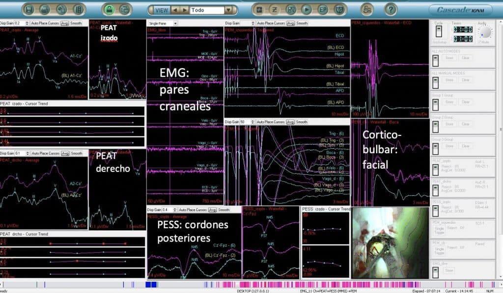 Figura 11. Imagen de la pantalla del neurofisiólogo durante una intervención  de cirugía de base de cráneo. Se registra simultánea y secuencialmente los PEAT, PESS, PEM transcraneales y EMG espontáneo y tras estimulación
