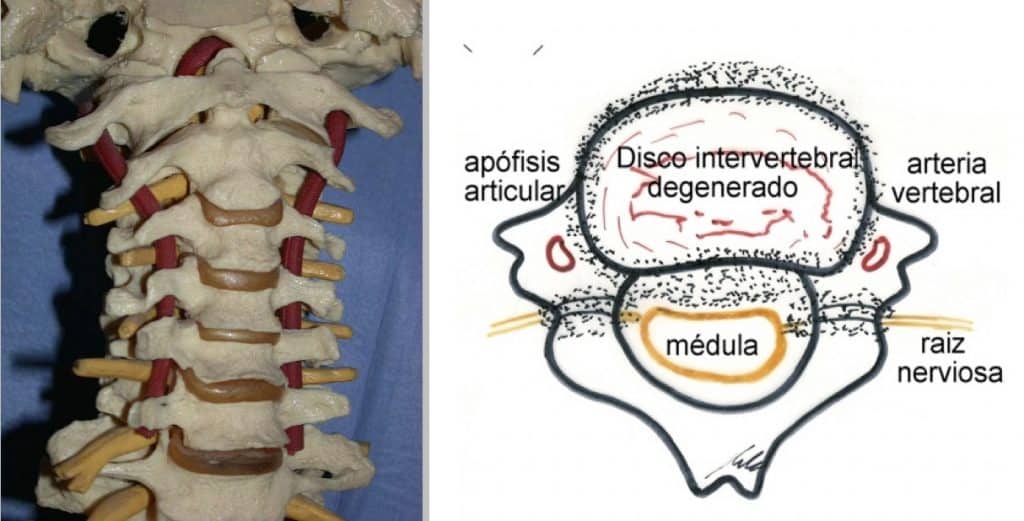 Figura 11.- Modelo de columna cervical. Se observa la situación de las arterias vertebrales y, en el esquema, la posibilidad de afectación de las arterias vertebrales por osteofitosis