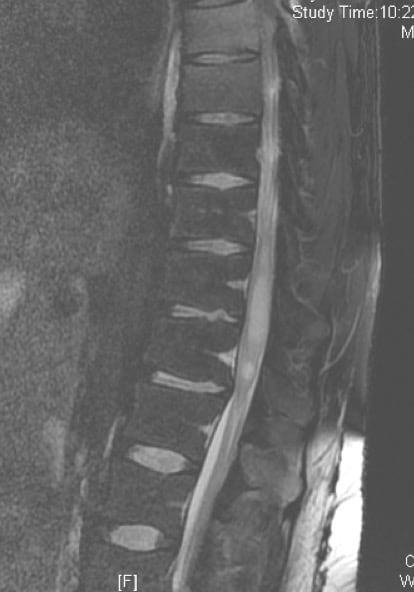 Figura 11.- RM dorsal: Astrocitoma difuso intramedular