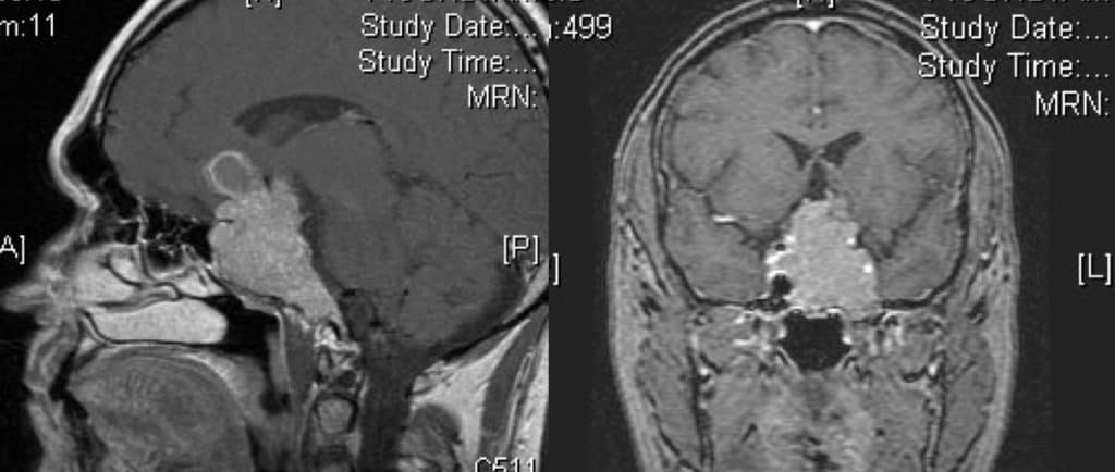 Figura 11.- RM sagital y coronal de macroadenoma hipofisario con extensión supraselar e invasión de senos cavernosos.