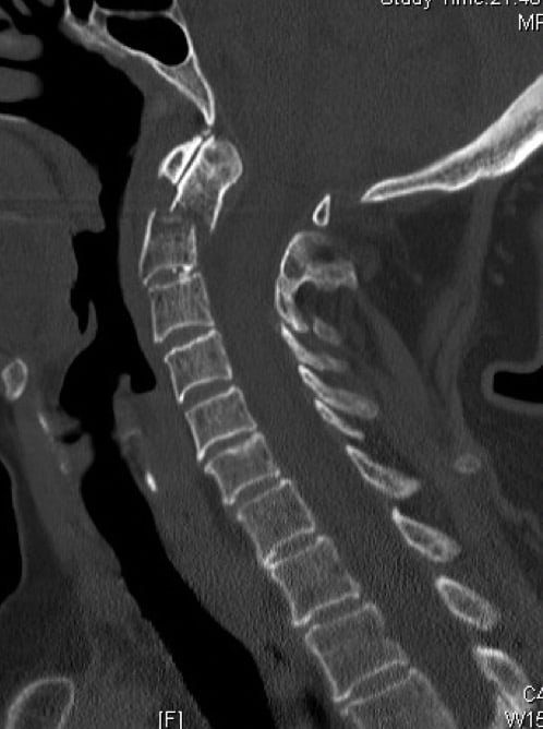 Figura 11.- TAC cervical con fractura de odontoides
