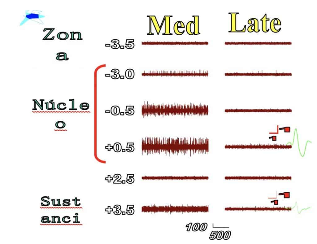 Figura 12. Ejemplo de micro-registros durante una intervención en enfermo con enfermedad de Parkinson. Se muestran registros a distintas profundidades (a la izquierda) para dos electrodos (medial y lateral, separados 2 mm). Se observan diferentes patrones celulares y cómo éstos marcan el inicio y fin (sólo en el electrodo medial) del núcleo subtalámico y la entrada en la sustancia negra. En la parte derecha se muestran ejemplos de potenciales de acción del núcleo subtalámico (arriba) y sustancia negra (abajo).