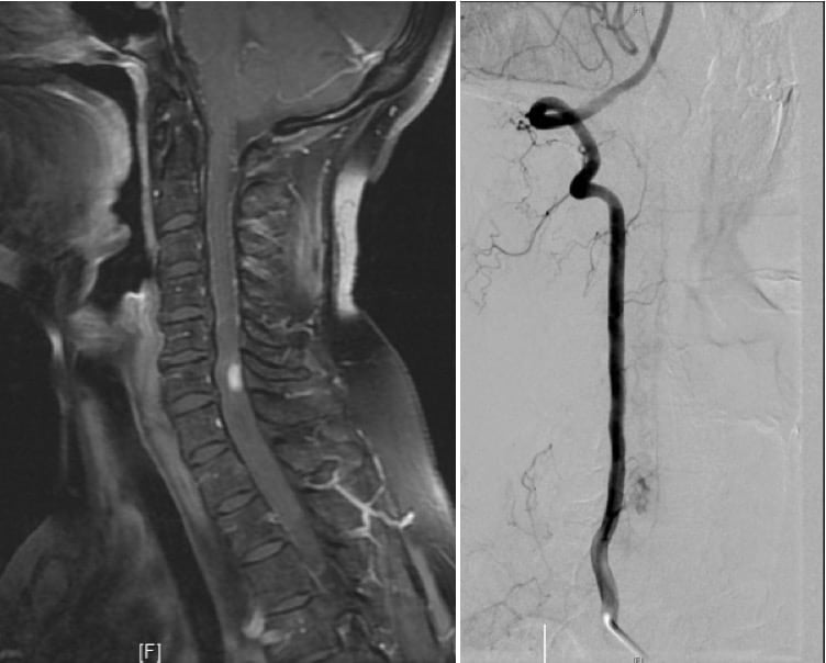 Figura 12.- RM cervical con hemangioblastom. Angiografía vertebral, mostrando nódulo vascularizado