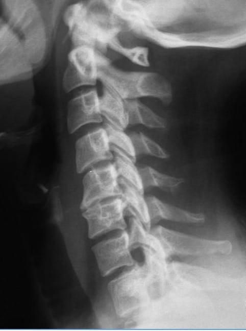 Figura 12.- RX lateral cervical con disminución del espacio discal C5-C6