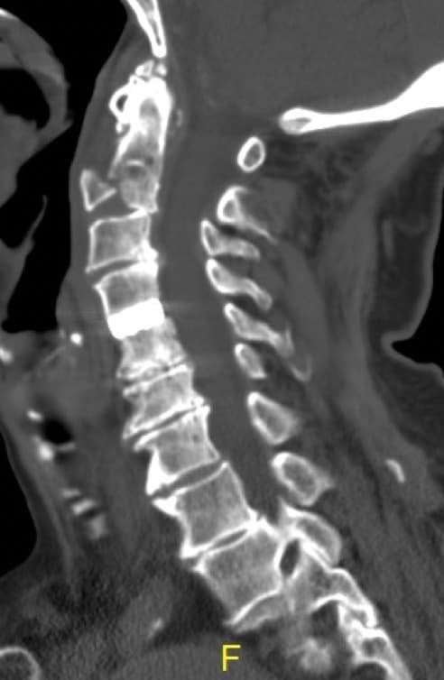 Figura 12.- TAC cervical de fractura de Hangman