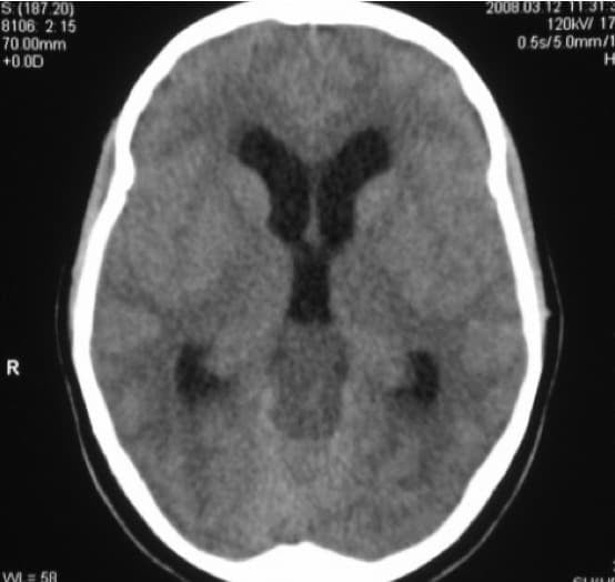 Figura 12.- TAC craneal con hidrocefalia por tumoración localizada a nivel pineal.