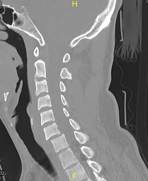 Figura 13.- TAC cervical de paciente con luxación cervical C6-C7
