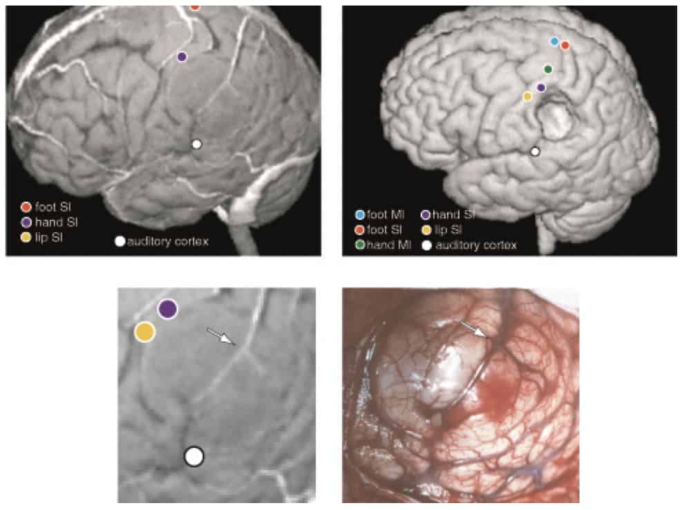 Figura  13.- Ejemplo de exploración MEG en un paciente con una lesión tumoral cortical, explorando PEM, PESS, PEA y lenguaje