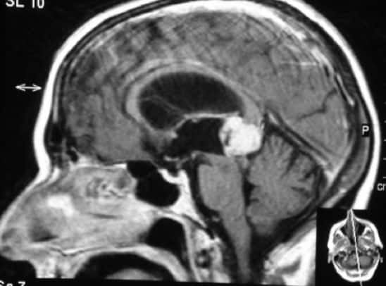 Figura 13.- RM craneal sagital con lesión a nivel de la glándula pineal y que produce hidrocefalia.