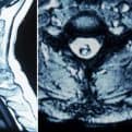 Figura 13.- RM sagital y axial con angioma cavernoso y hemorragia reciente