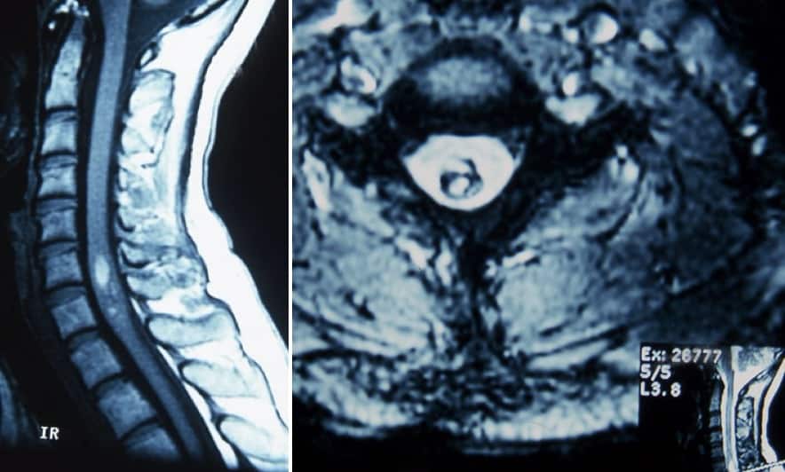 Figura 13.- RM sagital y axial con angioma cavernoso y hemorragia reciente
