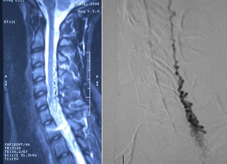 Figura 14.- RM y Arteriografia medular donde se observa la MAV cervical
