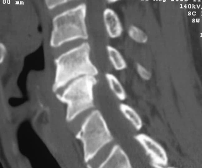 Figura 14.- TAC cervical. Se visualizan los osteofitos