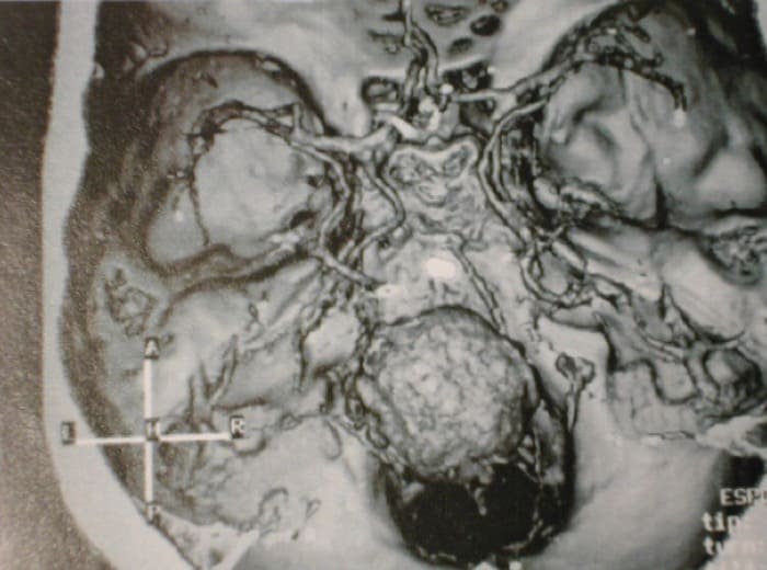Figura  14.- TAC craneal tridimensional: se observa un gran tumor (meningioma) en el agujero magno