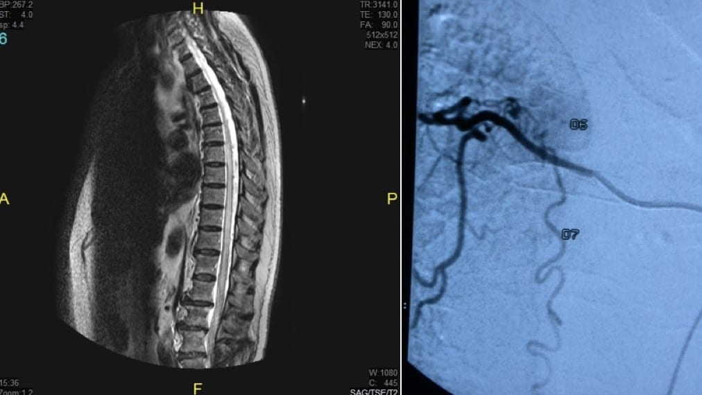 Figura 15.- Fístula dural. RM con edema intramedular e imágenes vasculares perimedulares. Angiografía mostrando un ovillo vascular a la izquierda arriba), la arteria radicular cateterizada y en el centro la vena de drenaje medular