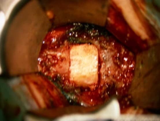 Figura 15.- Imagen quirúrgica del injerto óseo colocado en el espacio intervertebral