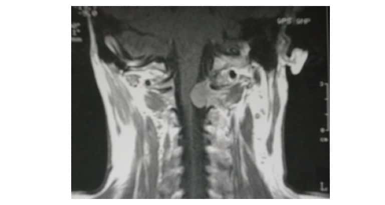 Figura  15.- RM de columna: se observa un tumor que comprime la médula