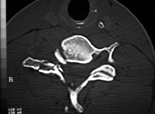 Figura 15.- TAC cervical. Fractura del cuerpo y apófisis articular