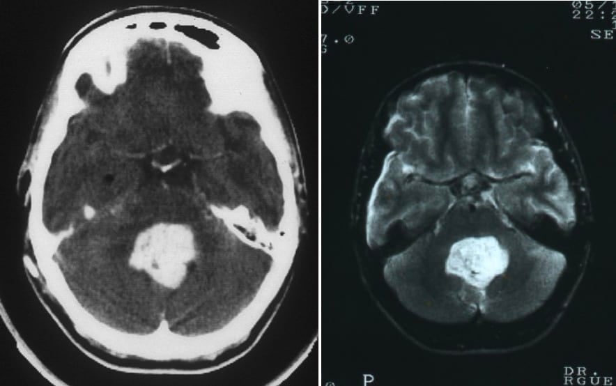Figura 15.- TAC y RM craneal de papiloma de plexos coroides del IV ventrículo.