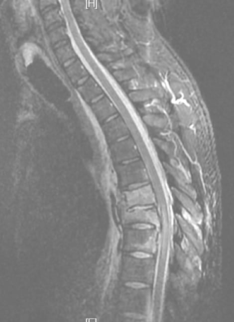 Figura 16.- RM dorsal. Fractura acuñamiento de dos cuerpos vértebrales dorsales