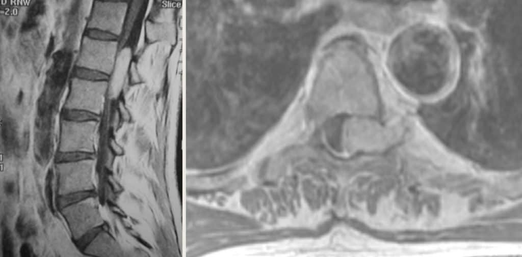 Figura 16.- RM sagital y axial de un neurinomaintra-extra dural