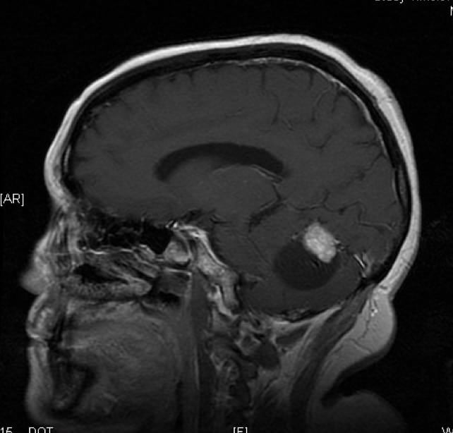 Figura 16.- RMN craneal de hemangioblastoma de cerebelo. Se observa la lesión quística y un nódulo de captación de contraste.